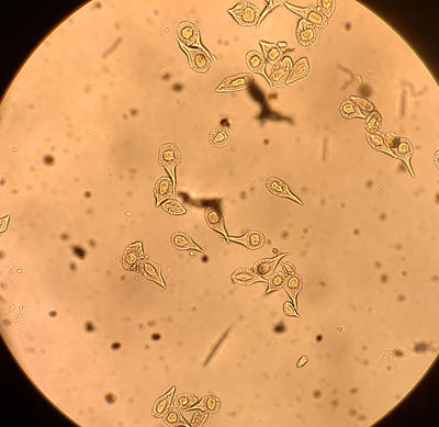 Microscopic view of aeciospores of Comandra rust. The tadpole or snowshoe-shaped aeciospres are different from those of other stem rusts. 